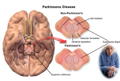 parkinson's disease
