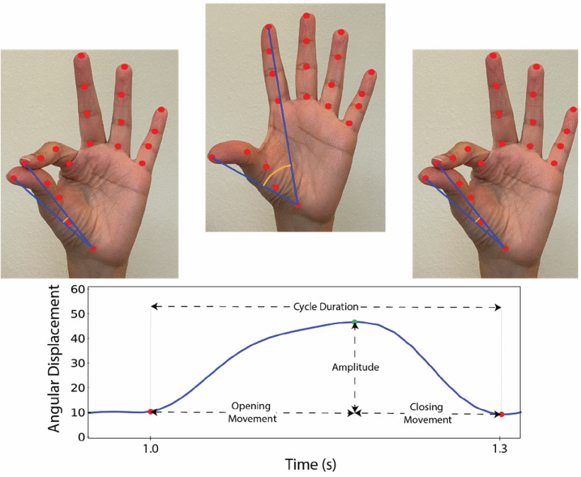 Hand tracking results provided by our video processing pipeline. We compute the angular distance between two vectors formed by joining the base of the hand with the tip of the index and thumb fingers as localized by Google’s MediaPipe in each video frame. The angular distance is tracked through the video to estimate an angular displacement signal. The bradykinesia related kinematic features are then computed from the peaks and valleys (green and red dots) of the angular displacement signal.