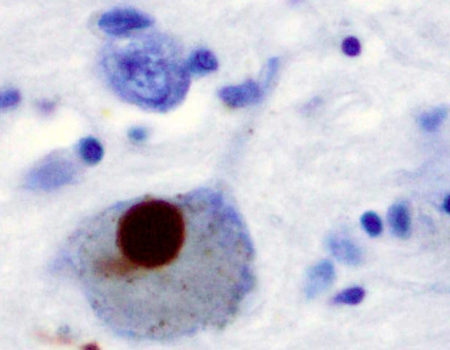 A brown spot on blue and white cells