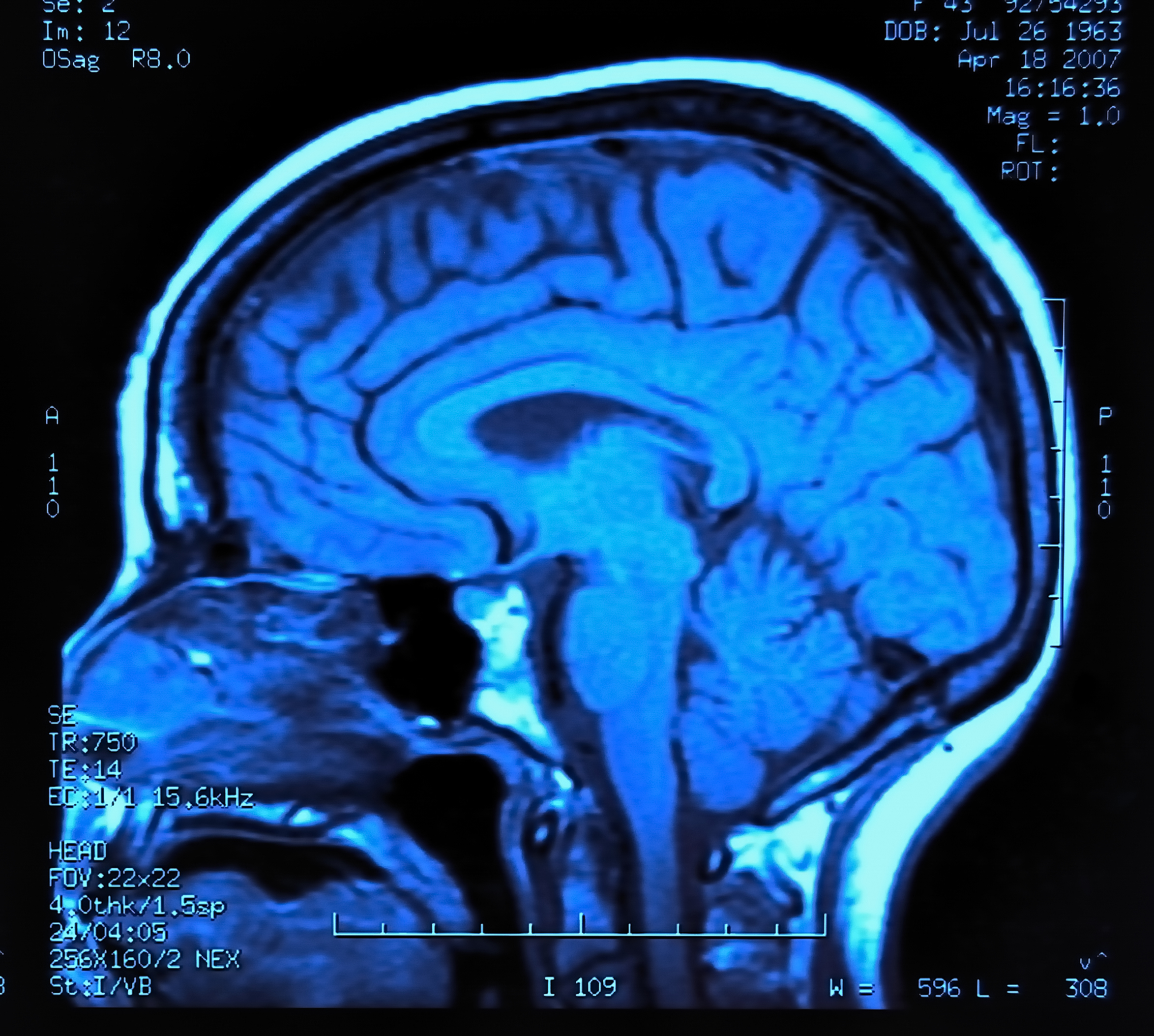 Brain MRI