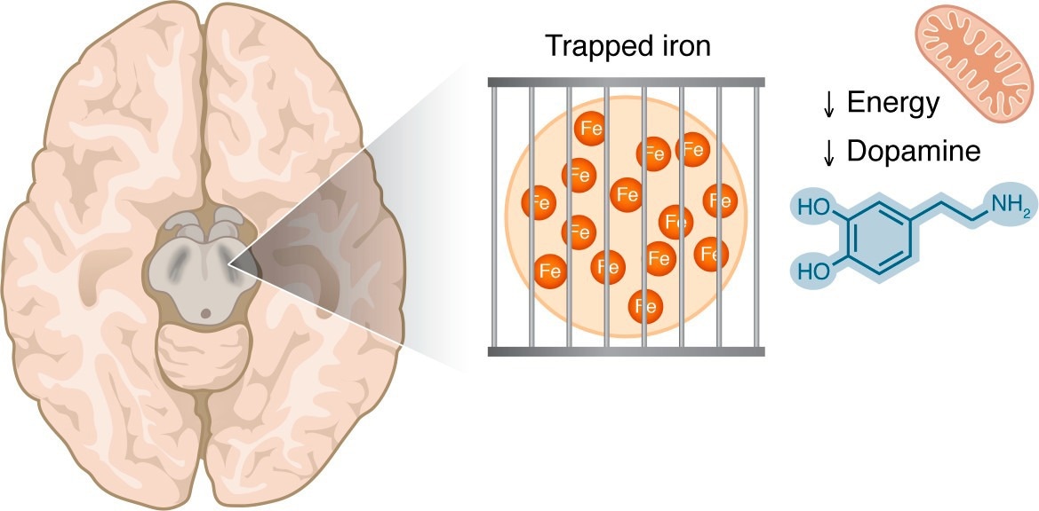 Iron accumulation in the substantia nigra is visible by MRI techniques in patients with PD. This iron may be in a trapped form, making it unavailable for the iron-dependent biological processes that are critical in dopaminergic cells, including mitochondrial respiration and dopamine synthesis.