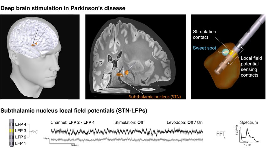 Deep brain stimulation alleviates Parkinson's symptoms - and allows insights into the activity of the subthalamic nucleus. These signals could one day enable a personalized therapy.  Detailed illustration of deep brain stimulation's role in Parkinson's, featuring subthalamic nucleus, electrode contacts, and local field potential signals.
