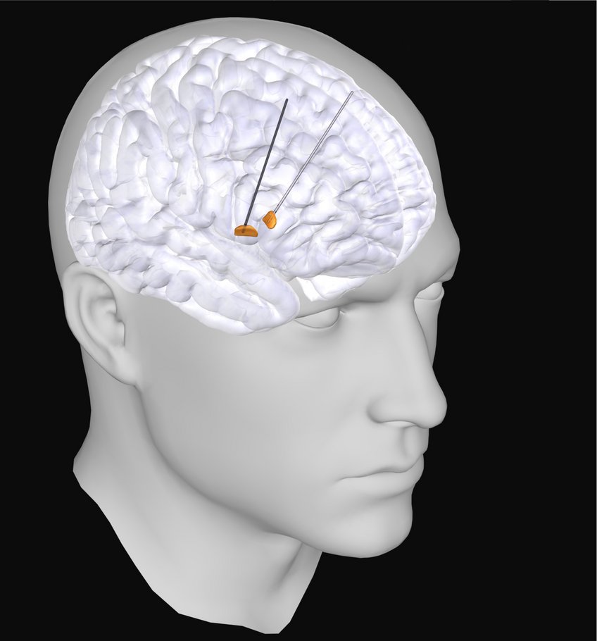 Scientists discovered a new electrical signature of Parkinson's Disease. Anatomical depiction of a human brain model, featuring multiple electrodes strategically positioned on the brain surface, highlighting the intricate brain structure and its connection points.