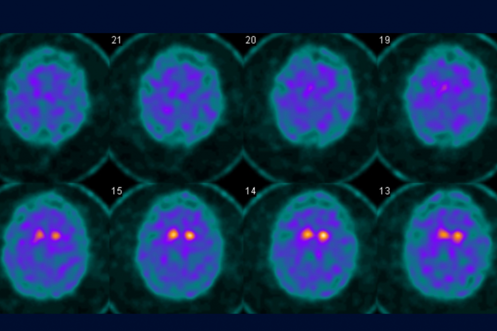 A colorful DaTscan showing reduced dopamine levels in the brain of a Parkinson's disease patient
