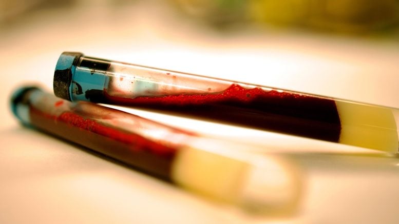 Blood Sample Parkinson's Test